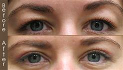 Blepharoplasty Surgery Results